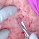 Image for article titled Dr. Pimple Popper, Now With Fart Jokes